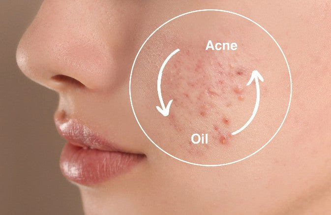 Close-up of a person's face with acne and oil.